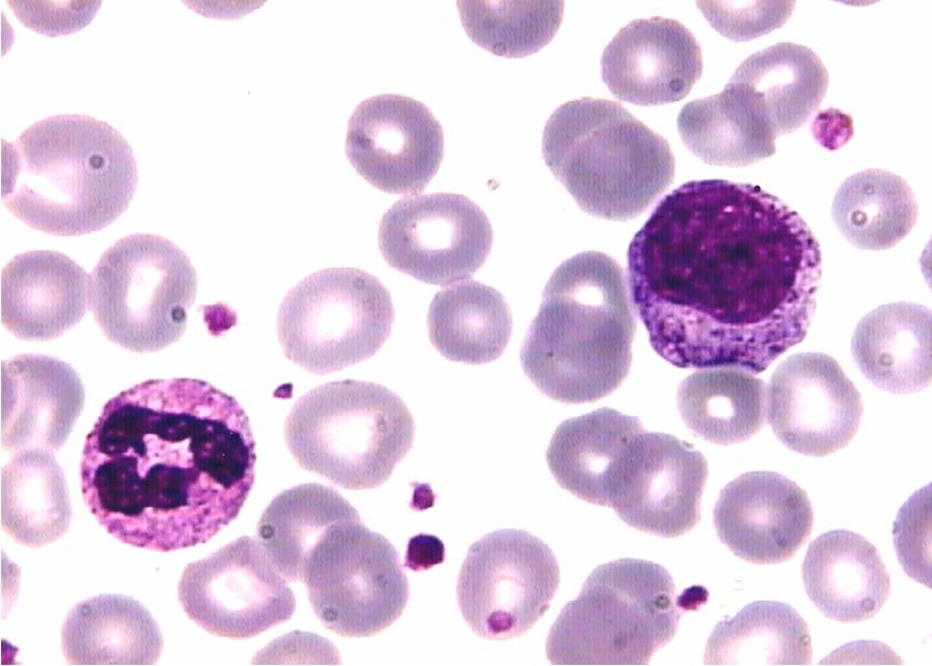 Imagem de amostra de sangue Leucemia Mielóide Crônica
