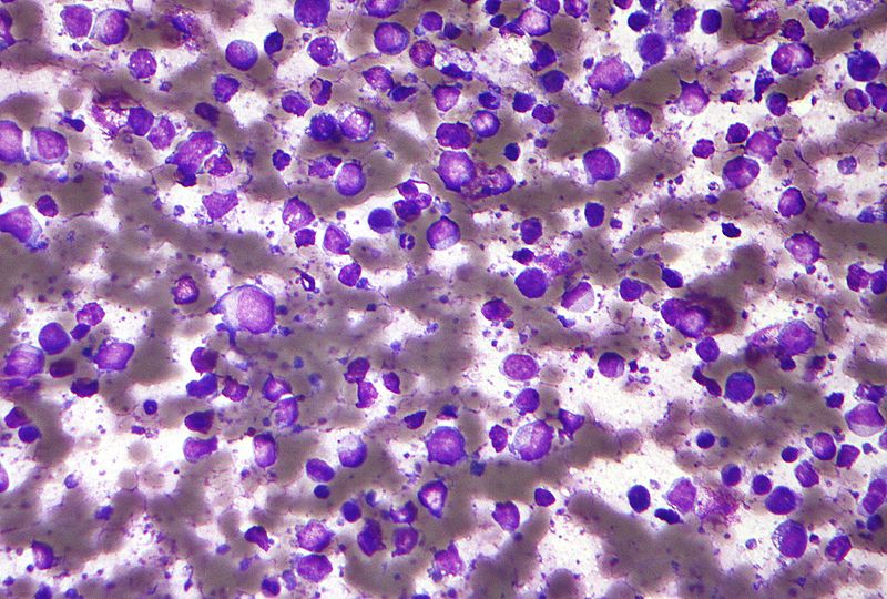 Imagem ampliada de sangue com lifoma difuso de grandes células B