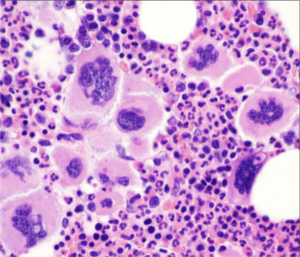 Sangue humano, amostra de Púrpura Trombocitopênica Idiopática